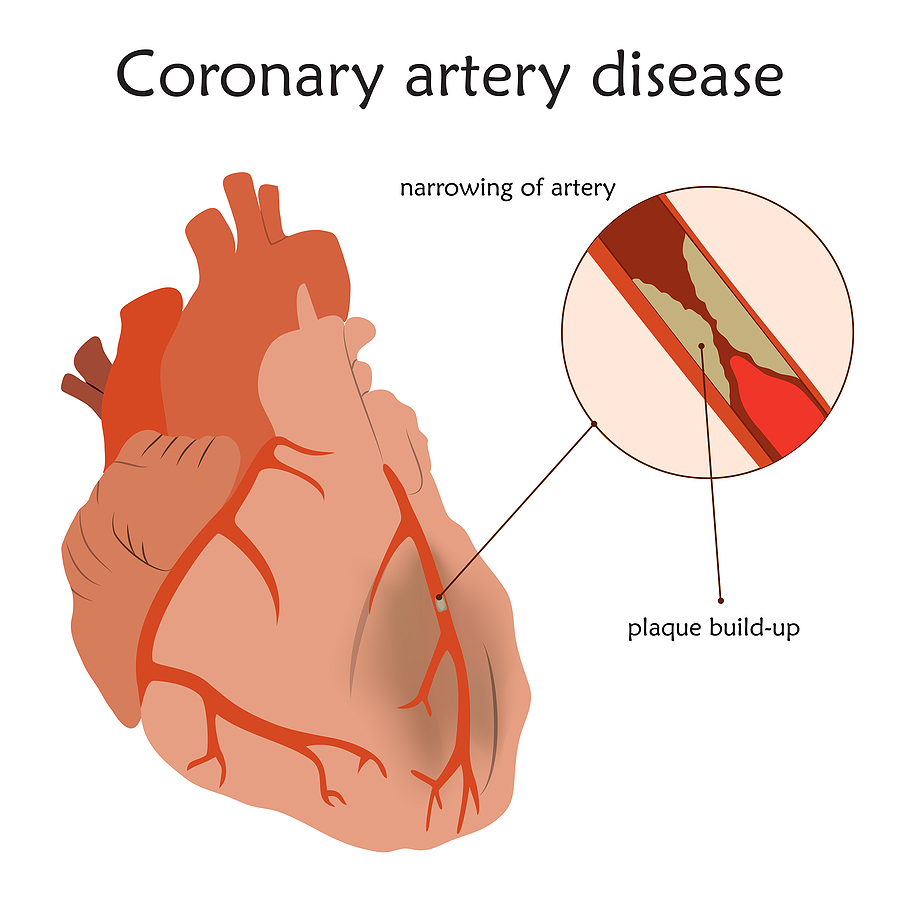 heart with coronary artery disease