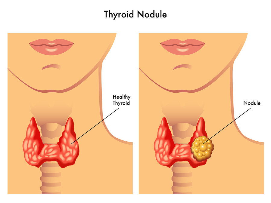 Understanding Thyroid Nodules