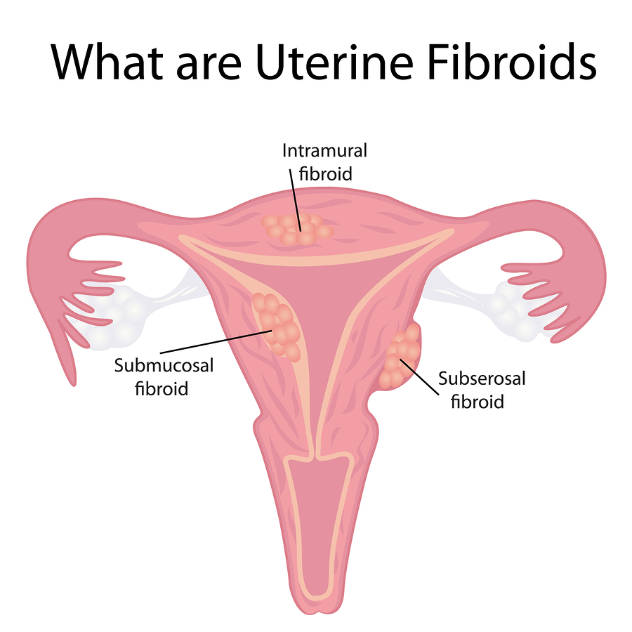 Are Uterine Fibroids Making You Miserable?
